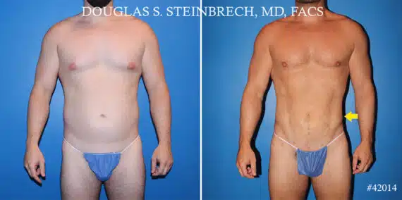 Body Banking Before and After Photos in CA, Beverly Hills, Patient 22040