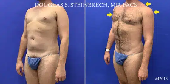 Body Banking Before and After Photos in CA, Beverly Hills, Patient 22056