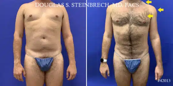 Body Banking Before and After Photos in CA, Beverly Hills, Patient 22056
