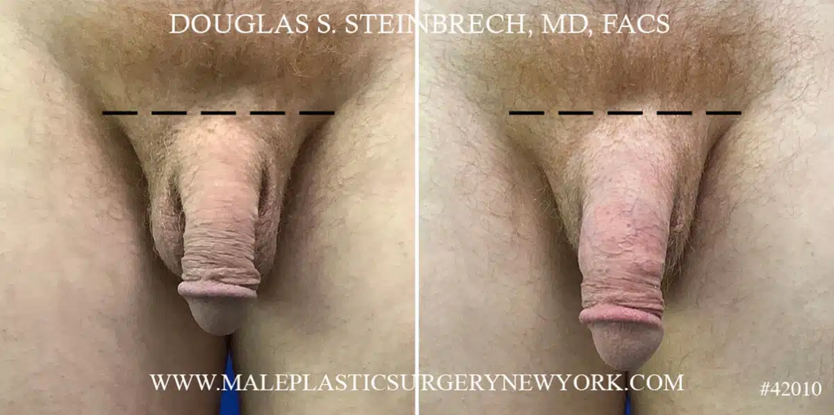 Male Enhancement Before and After Photos in CA, Beverly Hills, Patient 22072
