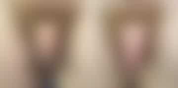 Male Enhancement Before and After Photos in CA, Beverly Hills, Patient 22072