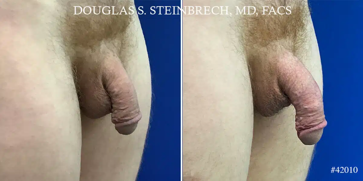 Male Enhancement Before and After Photos in CA, Beverly Hills, Patient 22072