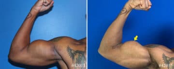 Biceps And Triceps Implants Before and After Photos in CA, Beverly Hills, Patient 22938