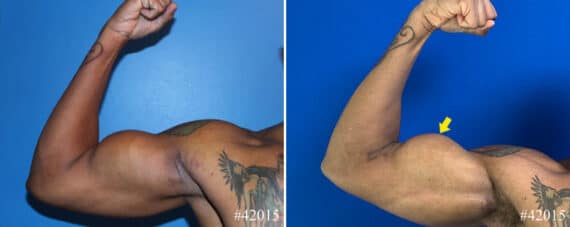 Biceps And Triceps Implants Before and After Photos in CA, Beverly Hills, Patient 22938
