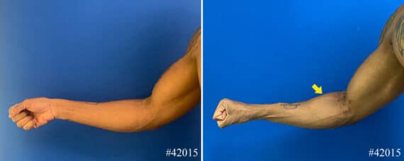 Biceps And Triceps Implants Before and After Photos in CA, Beverly Hills, Patient 22938