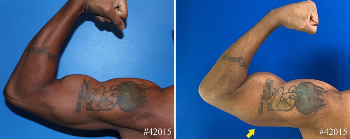Biceps And Triceps Implants Before and After Photos in CA, Beverly Hills, Patient 22938