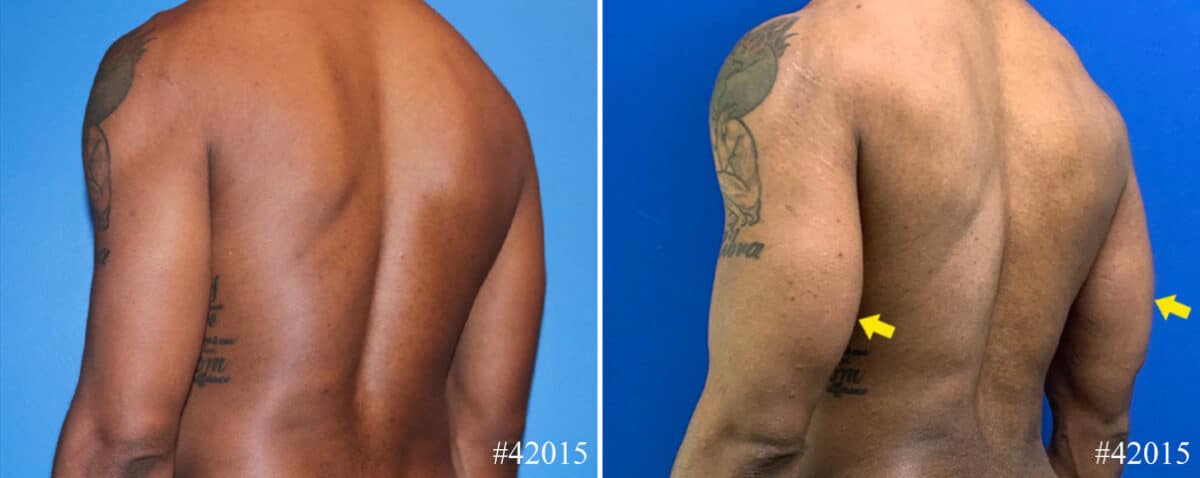 Biceps And Triceps Implants Before and After Photos in CA, Beverly Hills, Patient 22938