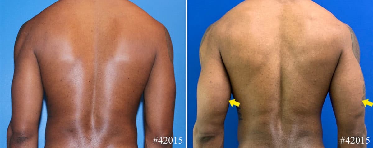 Biceps And Triceps Implants Before and After Photos in CA, Beverly Hills, Patient 22938