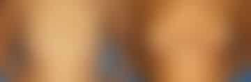 Breast Augmentation Before and After Photos in New York, NY, Patient 13926