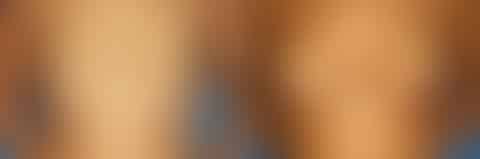 Breast Augmentation Before and After Photos in New York, NY, Patient 13926