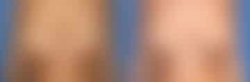 Breast Lift Before and After Photos in New York, NY, Patient 13973