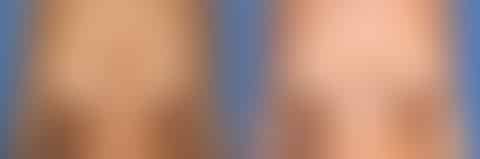 Breast Lift Before and After Photos in New York, NY, Patient 13973