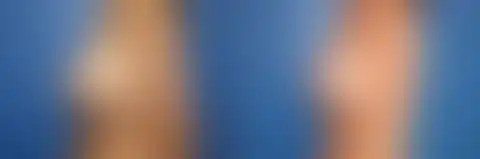Breast Lift Before and After Photos in New York, NY, Patient 13973