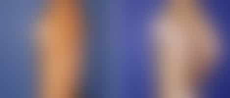 Breast Augmentation Before and After Photos in New York, NY, Patient 10760