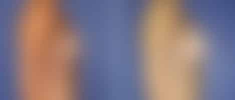 Breast Augmentation Before and After Photos in New York, NY, Patient 10760