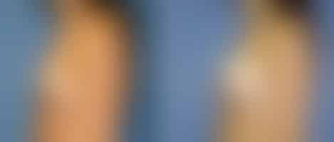 Breast Augmentation Before and After Photos in New York, NY, Patient 10775