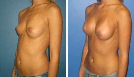 Patient 10795, Breast Augmentation Before and After Photos Breast Augmentation Before and After Photos in New York, NY, Patient 10795
