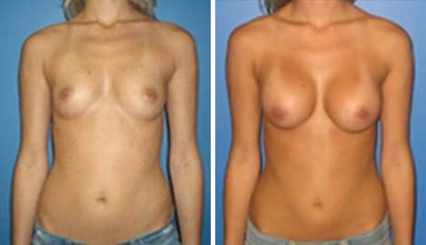 Patient 10795, Breast Augmentation Before and After Photos Breast Augmentation Before and After Photos in New York, NY, Patient 10795