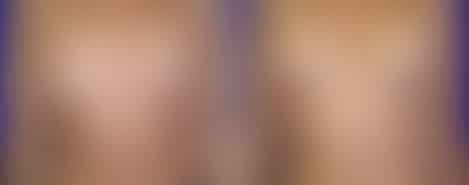 Breast Augmentation Before and After Photos in New York, NY, Patient 10801