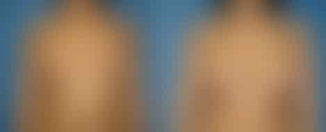 Breast Augmentation Before and After Photos in New York, NY, Patient 10807