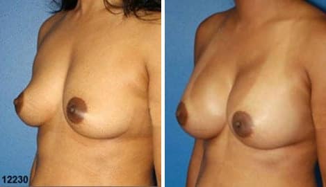 Patient 10817, Breast Augmentation Before and After Photos Breast Augmentation Before and After Photos in New York, NY, Patient 10817