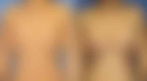Breast Augmentation Before and After Photos in New York, NY, Patient 10823