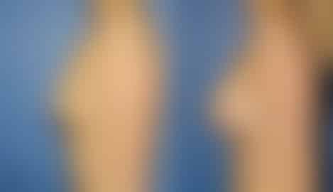 Breast Augmentation Before and After Photos in New York, NY, Patient 10829