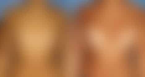Breast Augmentation Before and After Photos in New York, NY, Patient 10843