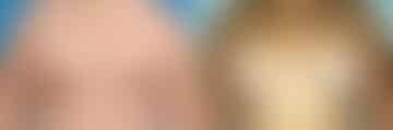 Specialty Breast Augmentation Before and After Photos in New York, NY, Patient 10883