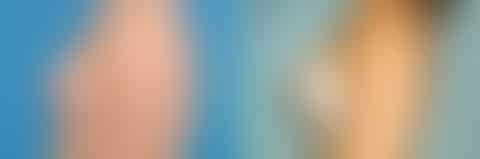 Specialty Breast Augmentation Before and After Photos in New York, NY, Patient 10883