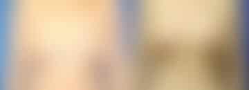 Breast Lift Before and After Photos in New York, NY, Patient 10890