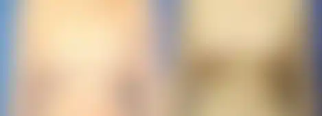 Breast Lift Before and After Photos in New York, NY, Patient 10890