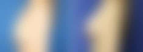 Breast Lift Before and After Photos in New York, NY, Patient 10890
