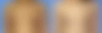 Breast Lift Before and After Photos in New York, NY, Patient 10951