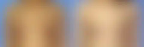 Breast Lift Before and After Photos in New York, NY, Patient 10951
