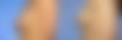 Breast Lift Before and After Photos in New York, NY, Patient 10951