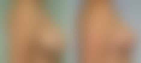 Breast Lift Before and After Photos in New York, NY, Patient 10957
