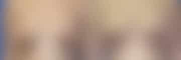 Breast Lift Before and After Photos in New York, NY, Patient 10961