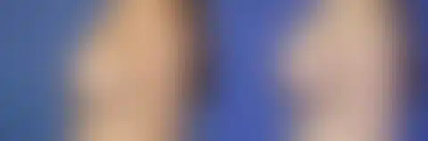 Breast Lift Before and After Photos in New York, NY, Patient 10961