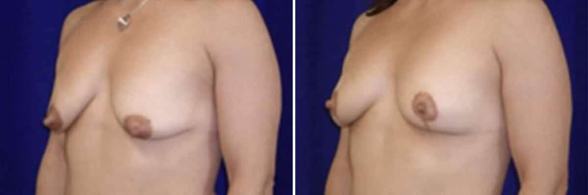 Breast Lift Before and After Photos in New York, NY, Patient 10973
