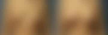 Breast Lift Before and After Photos in New York, NY, Patient 10977