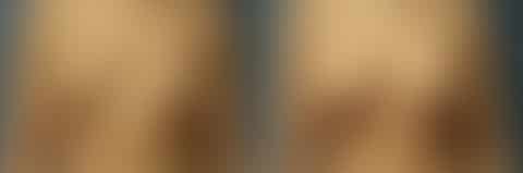 Breast Lift Before and After Photos in New York, NY, Patient 10977