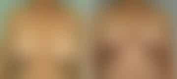 Breast Reduction Before and After Photos in New York, NY, Patient 10981