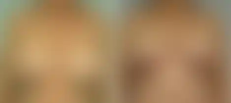 Breast Reduction Before and After Photos in New York, NY, Patient 10981