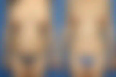 Mommy Makeover Before and After Photos in New York, NY, Patient 11060