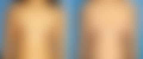 Breast Augmentation Before and After Photos in New York, NY, Patient 13512