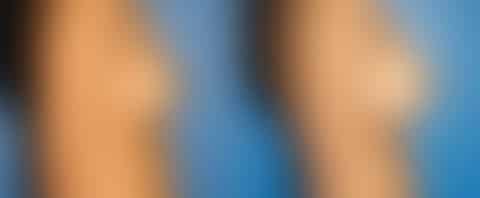 Breast Augmentation Before and After Photos in New York, NY, Patient 13512