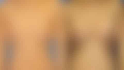 Breast Augmentation Before and After Photos in New York, NY, Patient 13525