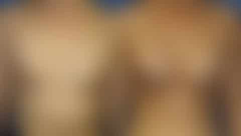 Breast Augmentation Before and After Photos in New York, NY, Patient 13541