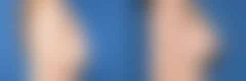 Breast Lift Before and After Photos in New York, NY, Patient 13567